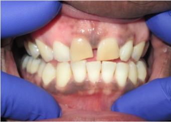 Actual Patient: Before Whitening