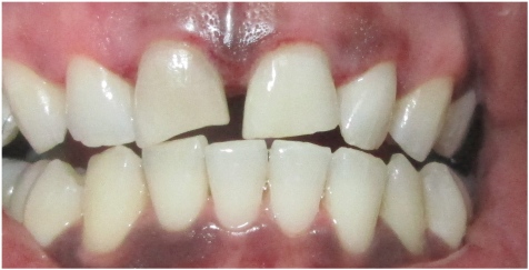 Actual Patient: After Whitening