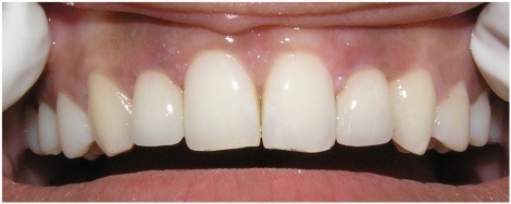 After: The teeth now have a more normal appearance, creating a more beautiful smile