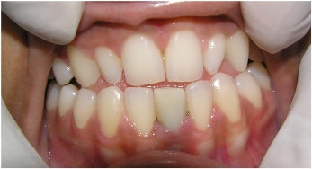 Before: Notice the smaller peg shaped teeth on either side of the front teeth.